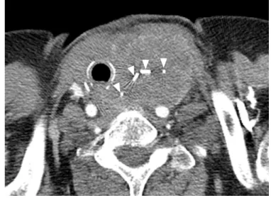 Fig.  2. A  mass  suggestive  of  recurred  primary  squamous  cell  carcinoma of the thyroid gland (PSCCT) in left neck 3 months  after surgery