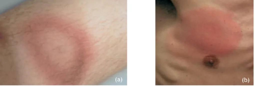 Figure 2- Examples of Erythema migrans. (a)- EM on the lower leg presenting central  clearing