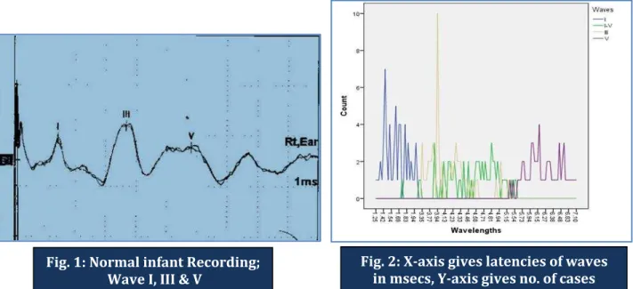 Fig. 2: X-axis gives latencies of waves  in msecs, Y-axis gives no. of cases 