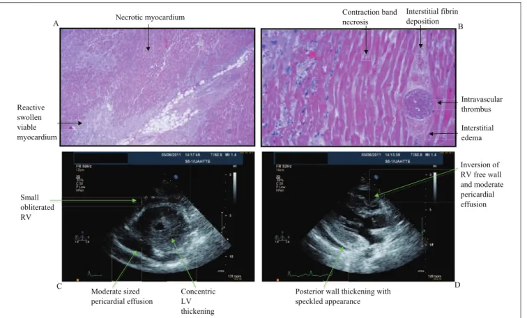 Figure 1. Pathologic and echocardiographic manifestations of cyclophosphamide-induced cardiac toxicity.