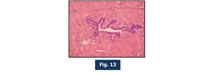 Fig.  13:  Photomicrograph  of  lactiferous  duct  in  Post-menopausal  mammary  gland  under  high  power (400X magnification)