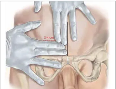 Figure 2 - Select the incision site
