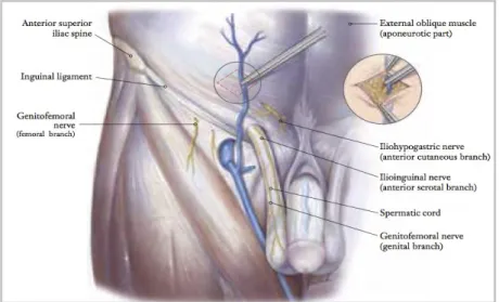 Figure 3 - Identification and cauterization of the superficial epigastric vein