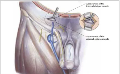 Figure 4 - Dissection to the level of the internal oblique aponeurosis