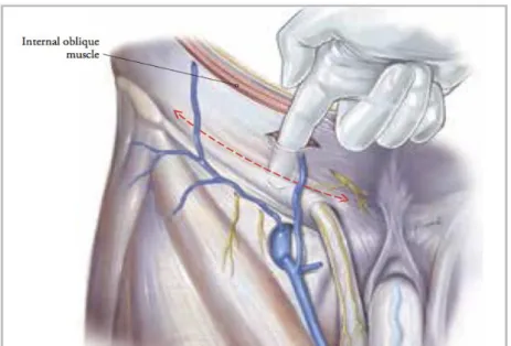 Figure  5  -  Development  of  the  plane  between  the  Internal  and  External  Oblique Aponeurosis