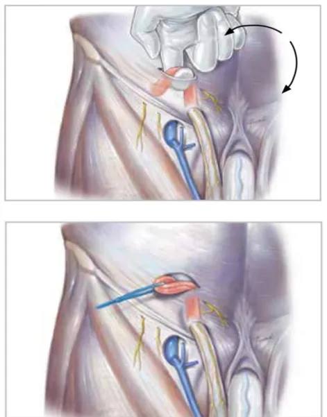 Figure 6 - Identification and Isolation of the Spermatic cord