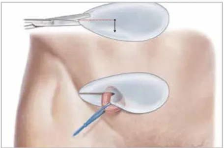 Figure 10 - Preparation of the POLYSOFT® Hernia Patch