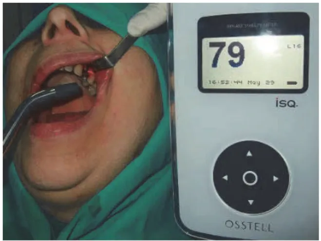 Fig. 1 – Postoperative low-level laser therapy. The  operational field was irradiated by laser probe positioned 