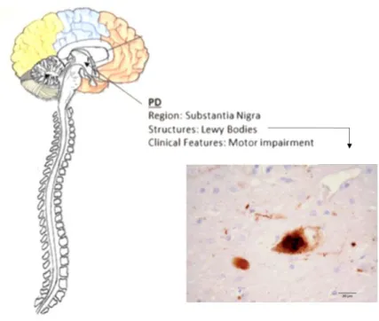 Figure 1.1. Schematic representation of PD  pathology. On the right, light microscopy of a neuronal cell containing LBs  (dark stain) [Lees et al, 2009]