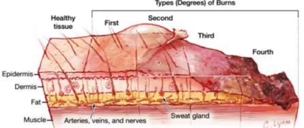Figure 3: Representation of the different degrees (first, second, third and fourth) of skin burn severity