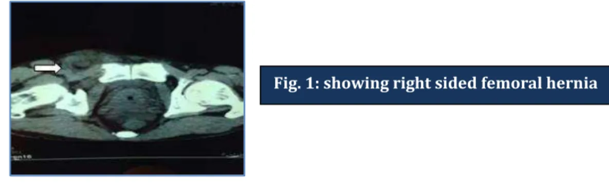 Fig. 1: showing right sided femoral hernia