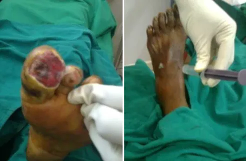 Fig 1: Diabetic foot ulcer                           Fig 2: 5ML is injected medial to medial To pedis                                                                                                                 pulsations   