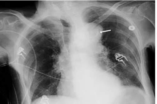 Figura 4. Radiografia torácica de um doente com dissecção aórtica com botão aórtico aumentado e sinal  de cálcio (seta branca)