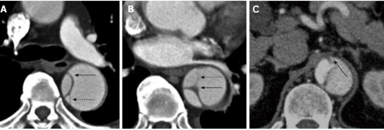 Figura 6. Imagens axiais de aortografia por TC. A e B – Sinal de teia de aranha: as imagens revelam um  flap  da  íntima/média  (setas)  com  “fios”  de  média  incompletamente  dissecada  (setas  tracejadas)