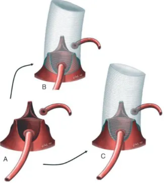 Figura 9. Procedimentos na raiz aórtica poupadores da válvula. A – Válvula aórtica reduzida ao mínimo
