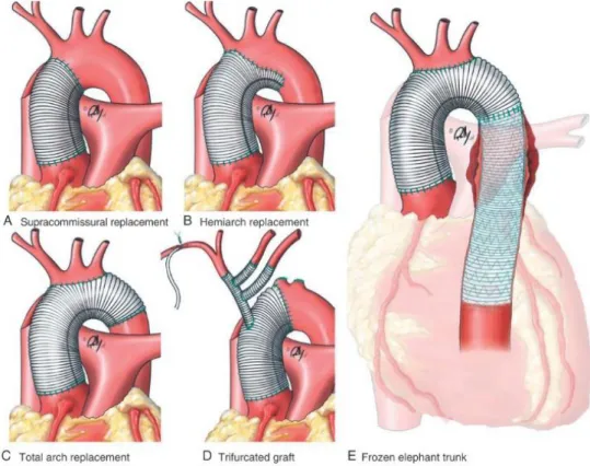 Figura 10. Técnicas cirúrgicas da DAA tipo A. A – Substituição da aorta ascendente acima das comissuras