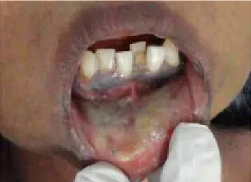 Fig. 1:  Case 1: uremic frost on lower labial mucosa