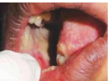 Fig. 4:  Case 2: Pseudomembranous uremic frost on   left side buccal mucosa