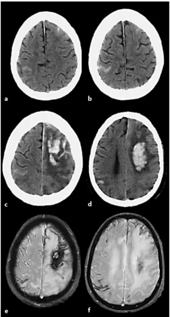 Fig. 1.  a, b A CT scan performed on admission with 2 circumscribed cortical subarachnoid hemorrhages, a  frontal left and a right parietal one