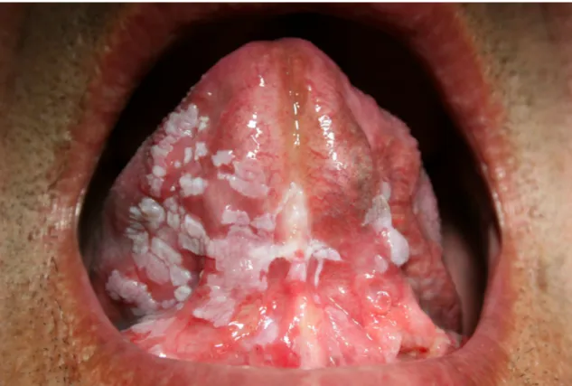 Figura 1- Na imagem observa-se a face ventral da língua e pavimento lingual com  alterações da mucosa oral: leucoplasia salpicada