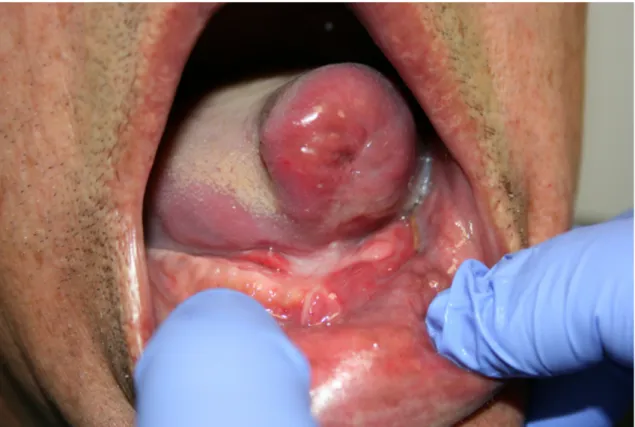 Figura 2- Paciente após o procedimento cirúrgico tendo-se realizado excisão das  alterações e reconstrução cirúrgica da língua