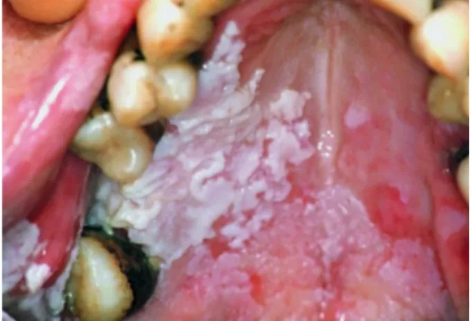 Figura 3- Leucoplasia verrucosa proliferativa. São vísiveis várias placas brancas espessas,  disseminadas e abrangentes