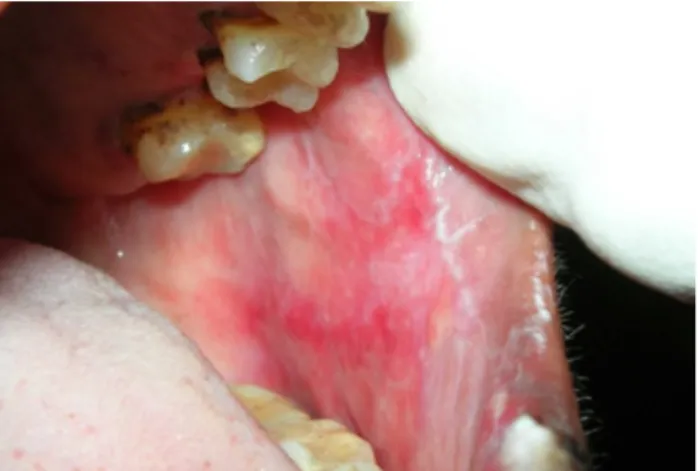 Figura 10- Líquen plano erosivo na mucosa jugal. São visíveis áreas eritematosas de  erosão intercaladas com estrias de Wickham