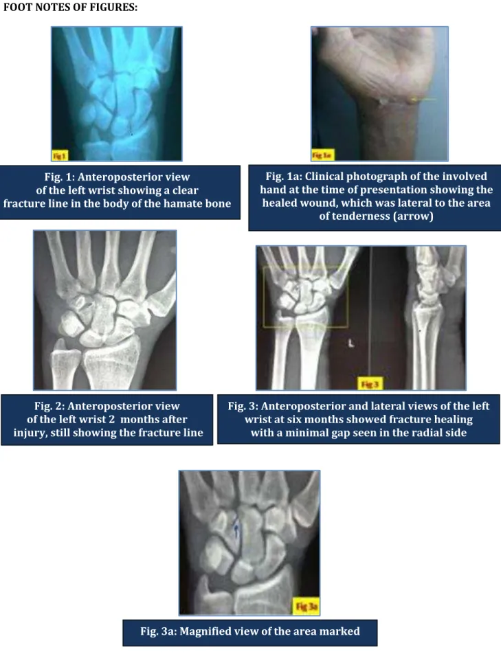 Fig. 3: Anteroposterior and lateral views of the left   wrist at six months showed fracture healing  
