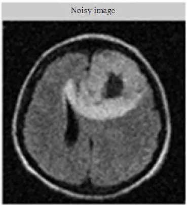 Fig. 3. Noisy MRI image of human brain 