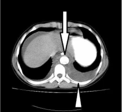 Figure  3.  The  next  cut  of  computed  tomography scan showing aortic wall flap 