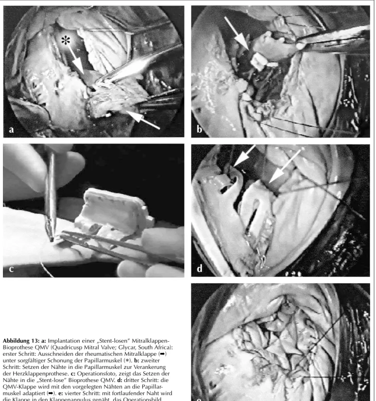 Abbildung 13: a: Implantation einer „Stent-losen” Mitralklappen- Mitralklappen-Bioprothese QMV (Quadricusp Mitral Valve; Glycar, South Africa):