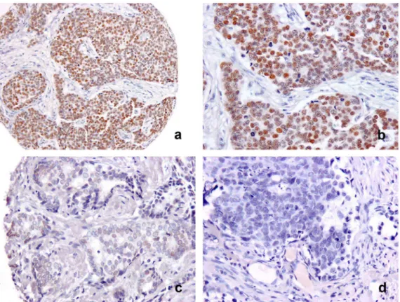 Figure 2. Nuclear DACH1 immunostaining varied in intensity from being strong with expression in a high proportion of cells (a, b), to weak (c) or negative (d), in breast carcinoma.