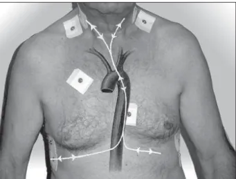 FIGURE 1. Location of eight basic and two accessory electrodes on  patient’s chest for thoracic electrical bioimpedance application.