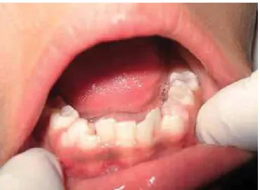 Fig. 2: Mandibular arch showing mixed dentition