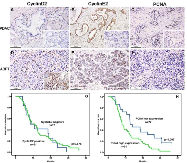 Figure 2. Immunohistochemical expression of cyclin D2, cyclin E2, and PCNA in PDAC tissues as well as overall survival