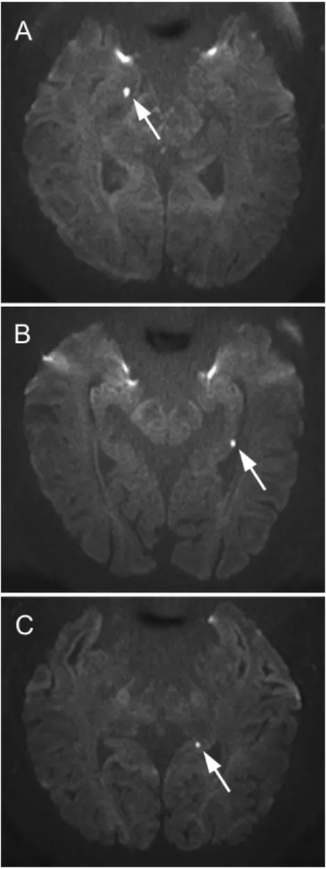 Figure 1. Examples of hippocampal head, body and tail lesion on diffusion-weighted imaging