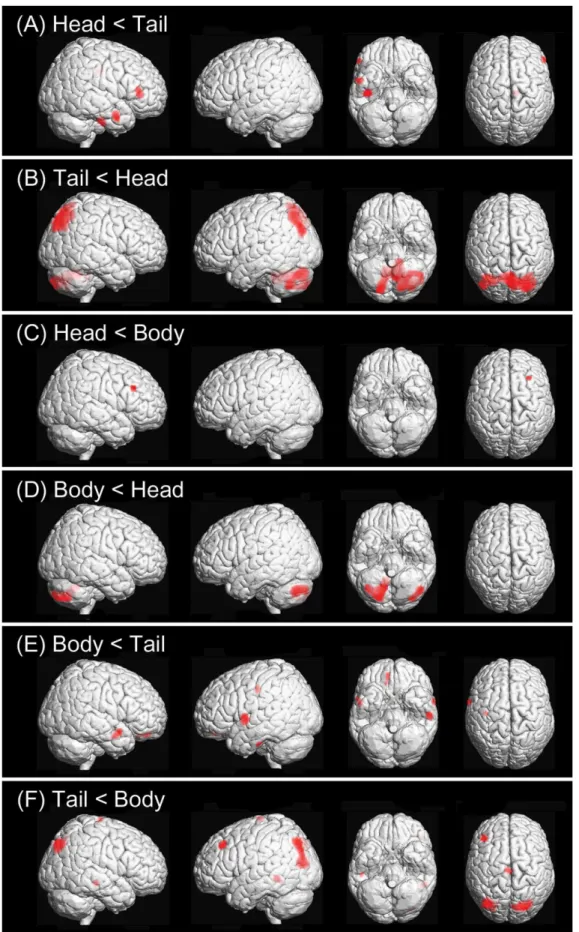 Figure 2. Areas of hypoperfusion in relation to the longitudinal location of the hippocampal lesion