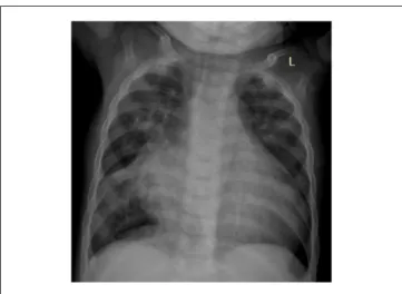 Figure 1.  Chest X-ray (AP view) displaying cardiomegaly,  increased vascular markings, and right lower lobe consolidation.