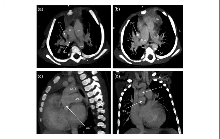 Figure 2.  (a) Cardiac computed tomography scan (CT; axial view) showing right pulmonary artery arising from the ascending aorta