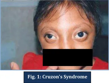 Fig. 1: Cruzon’s Syndrome 