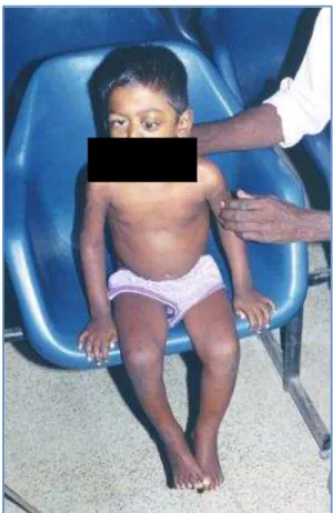 Fig. 5: Bilateral Proptosis due to Secondaries from Neuroblastoma