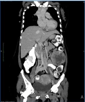 Fig. 1: Coronal Reformate showing   Duplication of IVC 