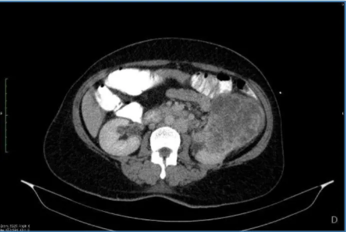 Fig. 4: Post-Nephrectomy Photograph showing Left-Sided  IVC with the Bowel having been Mobilised Medially and 
