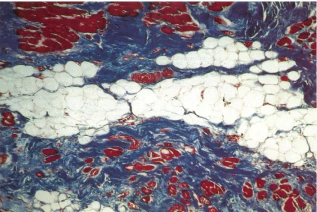 Figura 3 – Corte histológico de VD, mostrando infiltração por tecido fibro- fibro-adiposo (Fonte: Mckenna et al, 1994)