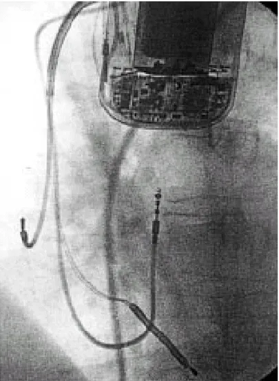 Figura 10 – Radiografia torácica de paciente com CID (Fonte: Corrado et al,  2000). 