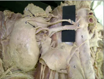 Figure 1. Abdominal aorta on the right side showing the origin of renal  artery and aberrant renal artery