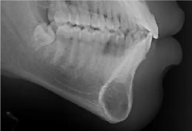 Figura  2:  Radiografia  Panorâmica  em  aumento  evidenciando lesão radiolúcida em sínfise mandibular 