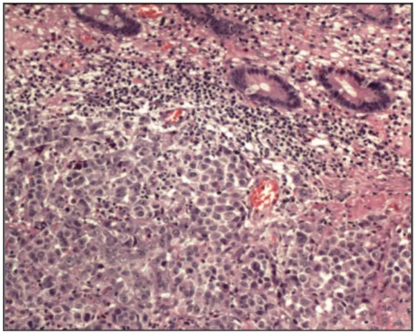 Figura 2 – Segmento de jejuno evidenciando segmento  de  alça  “teloscopando”  dentro  da  outra  associada  à  lesão em mesentério 