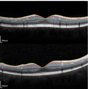 Fig 4. Vertical optical coherence tomography scan images (1:1 pixel views) showing a representative image in eyes with traumatic optic neuropathy (TON) within 3 weeks after trauma (early TON)