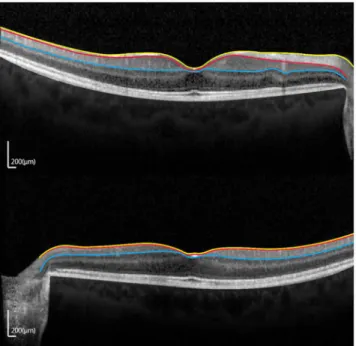 Fig 3. Optical coherence tomography scan images (1:1 pixel views) showing the representative images in eyes with unilateral traumatic optic neuropathy (TON)